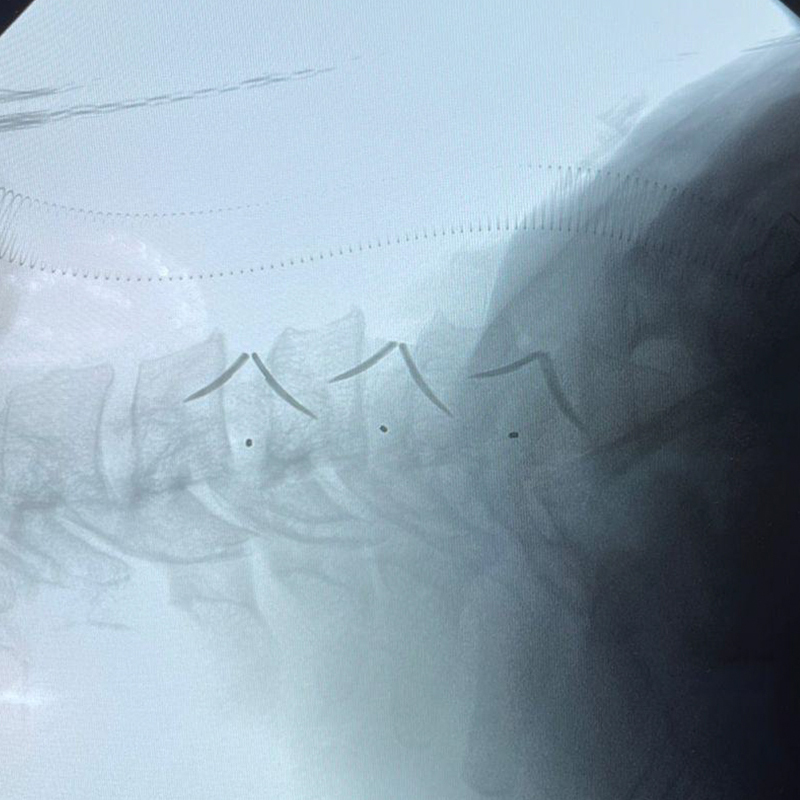 Radiograf&iacute;a de columna cervical lateral posoperatoria