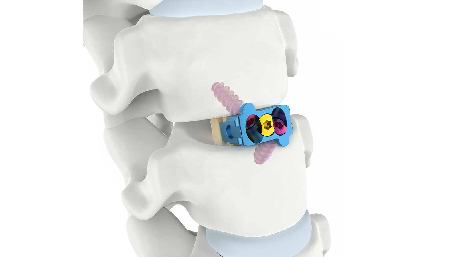 Sistema de fusión intersomática cervical