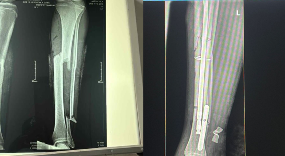 Fractura de tibia en México tratada con experto en tibia Clavo y Placa