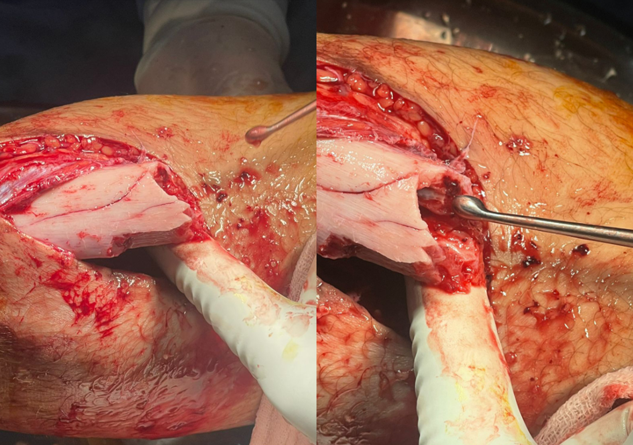 Fotograf&iacute;as intraoperatorias que muestran la reducci&oacute;n de la fractura de tibia y la colocaci&oacute;n del implante. 