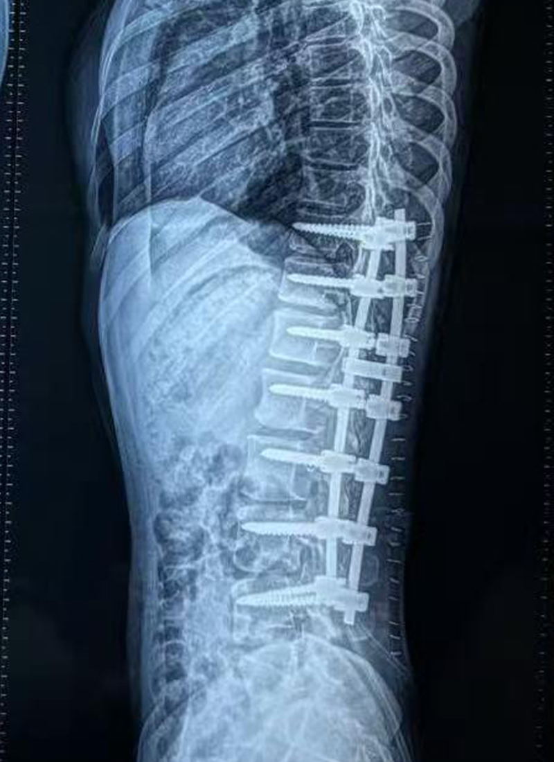 Radiograf&iacute;a lateral preoperatoria