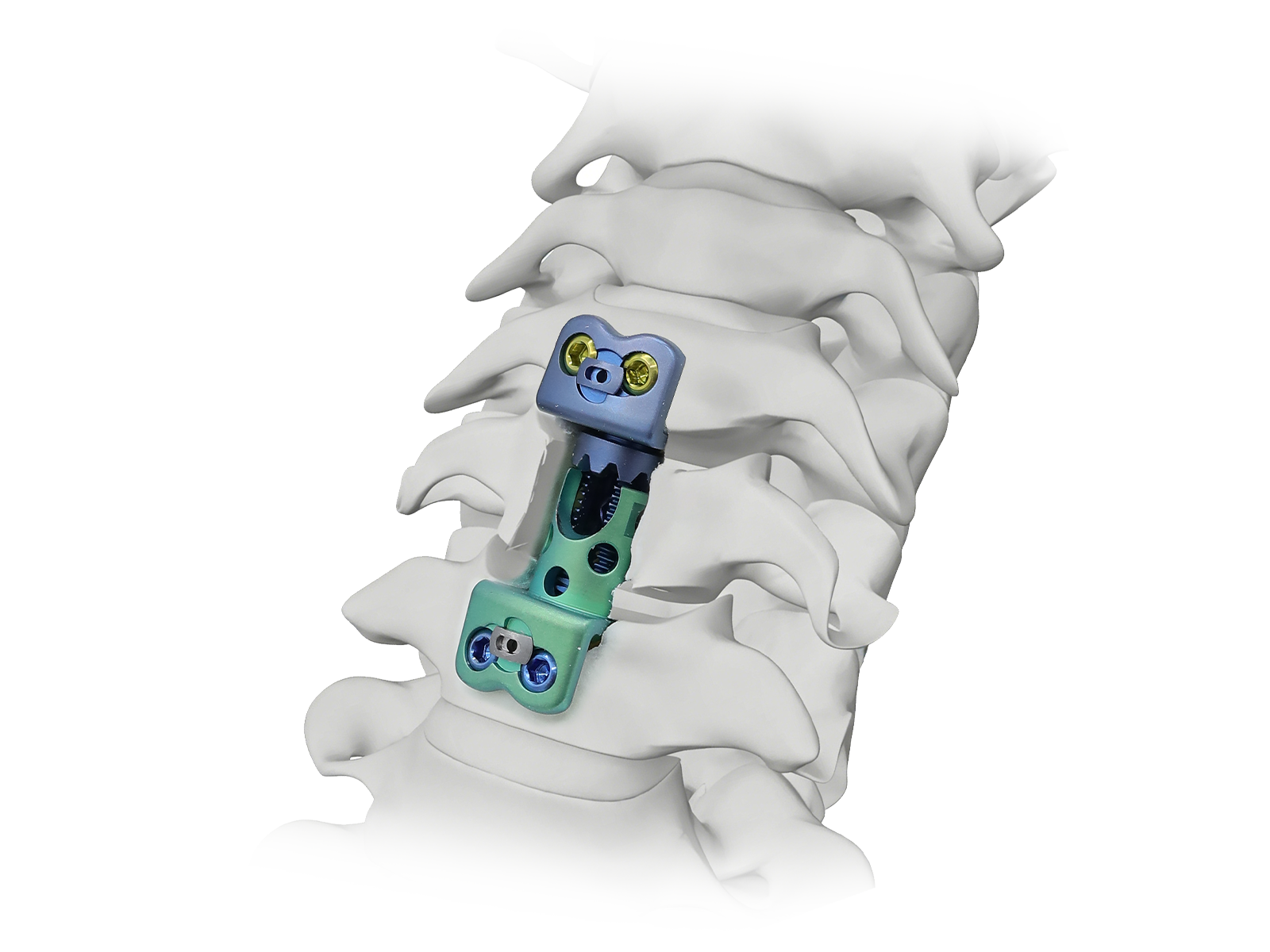 Sistema de reemplazo del cuerpo vertebral