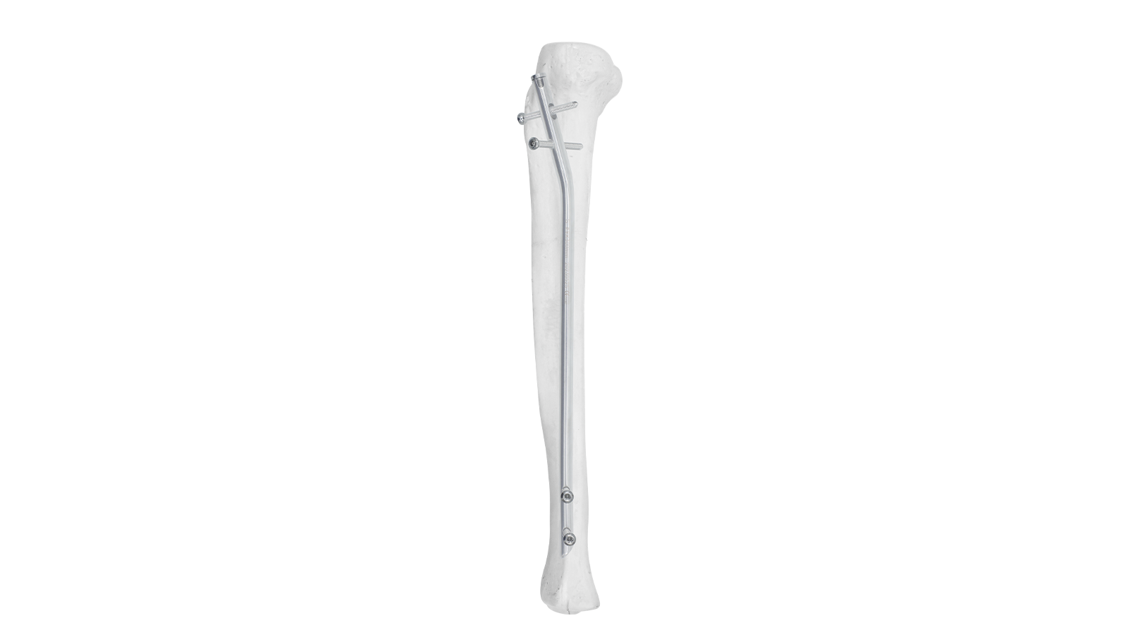 Clavo intramedular tibial ARVO™