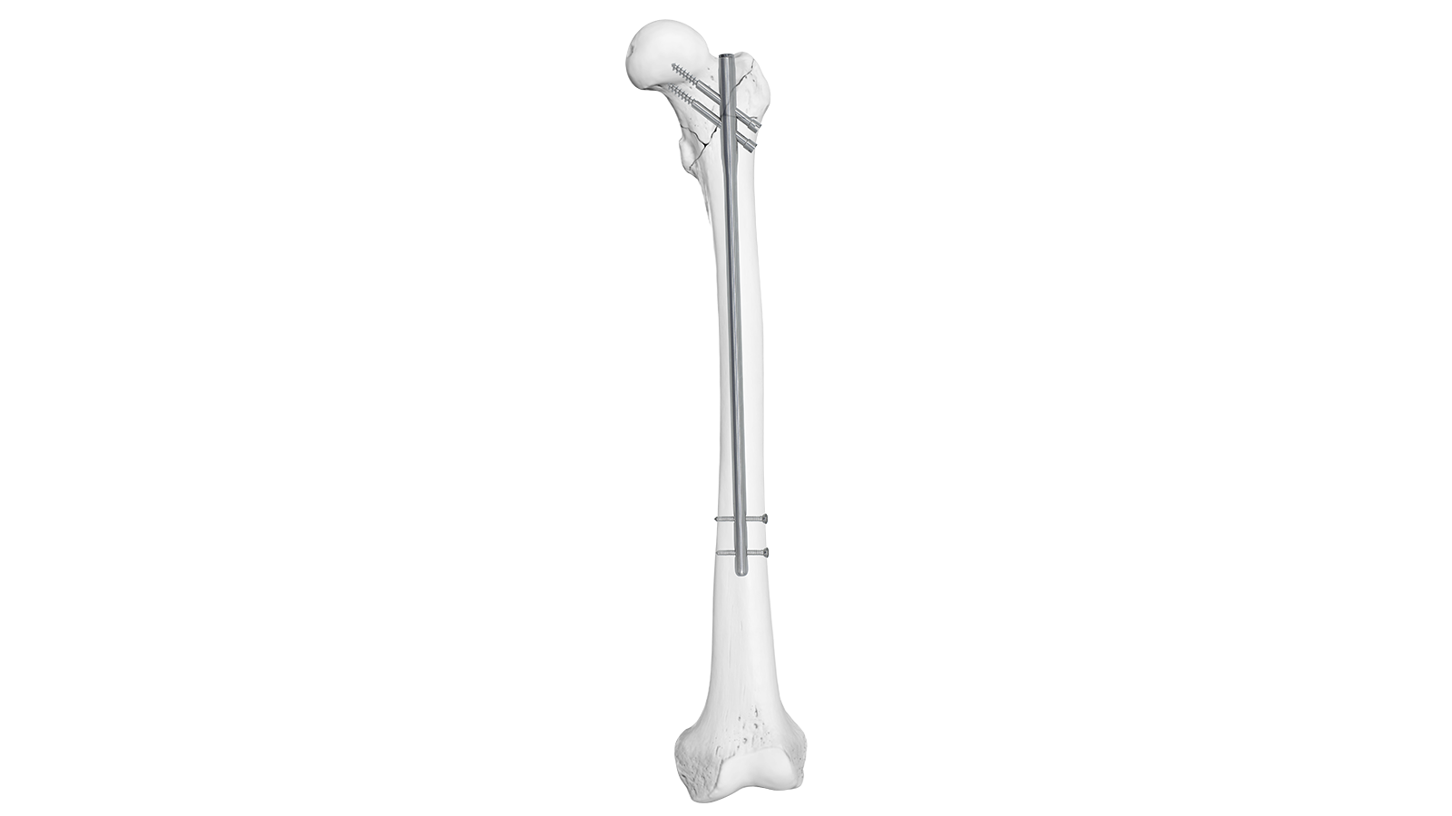 Clavo intramedular de reconstrucción femoral ARVO™