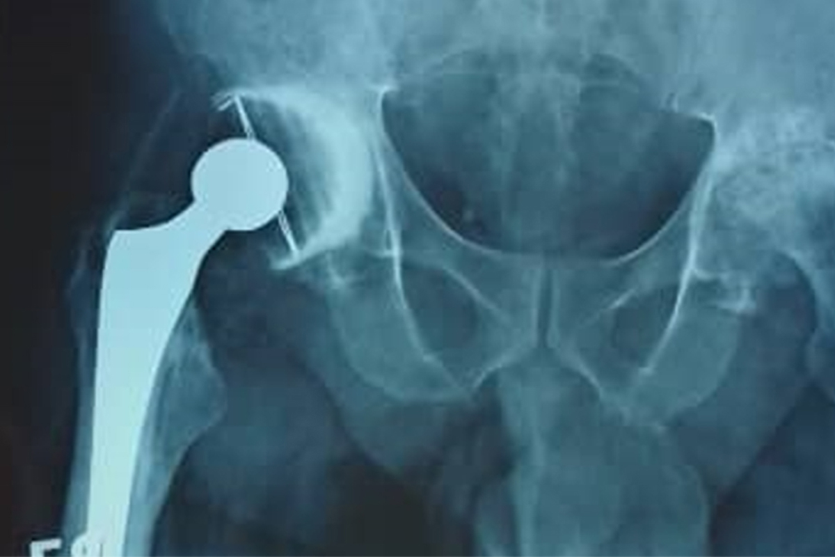 Radiograf&iacute;a posoperatoria inmediata con pr&oacute;tesis de cadera derecha cementada 