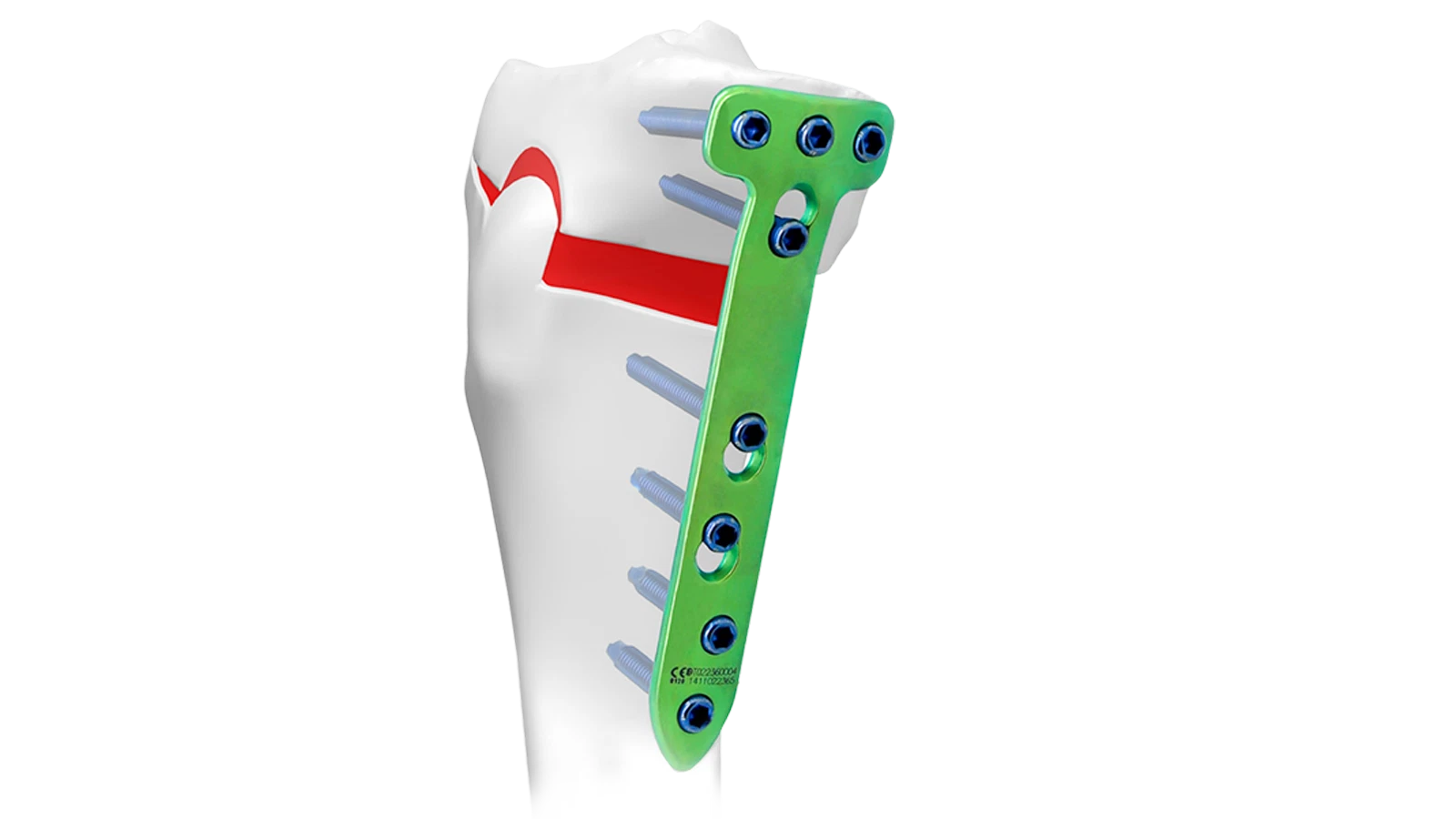 Osteotomy locking plate system