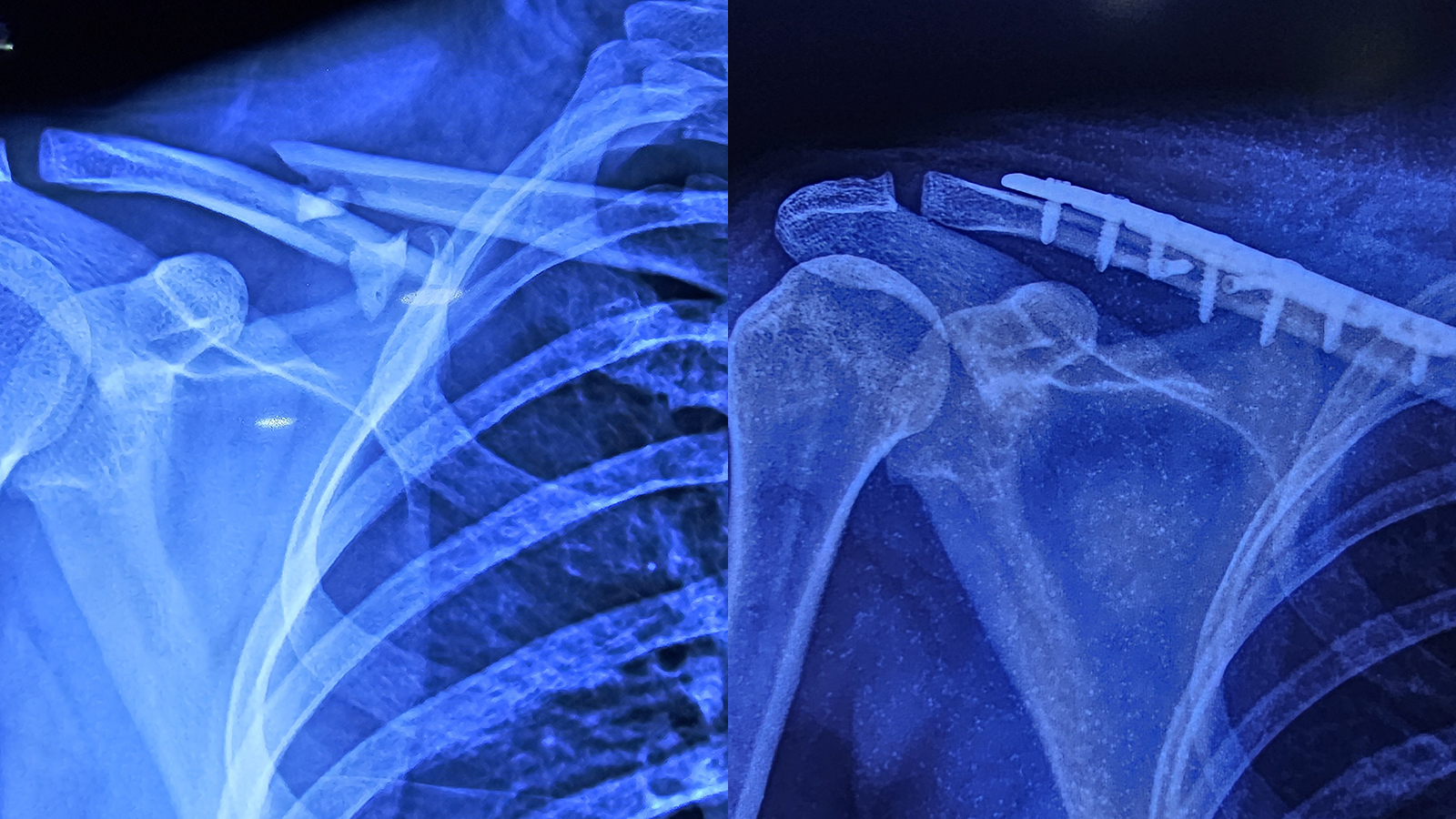 Tratamiento exitoso de fractura de clavícula con placa de bloqueo de clavícula en S